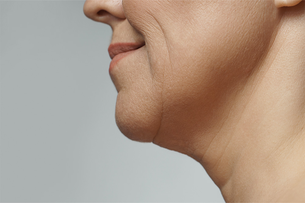 Traditional or Full Facelift - Illumia Medical