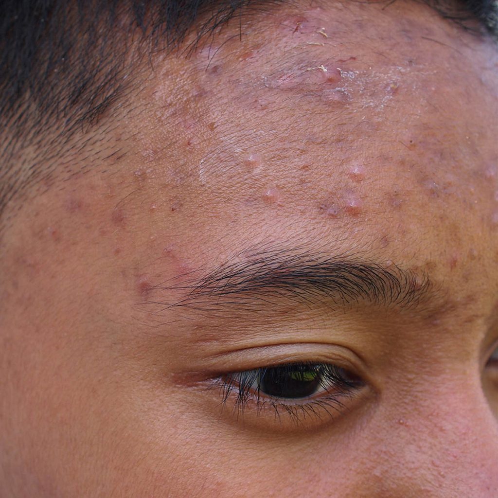 Acne Scars Singapore