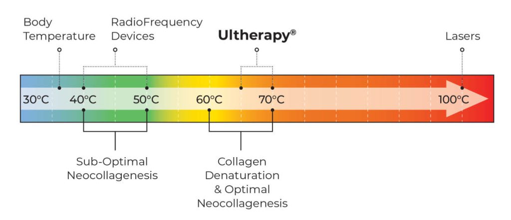 How Does Ultherapy Works