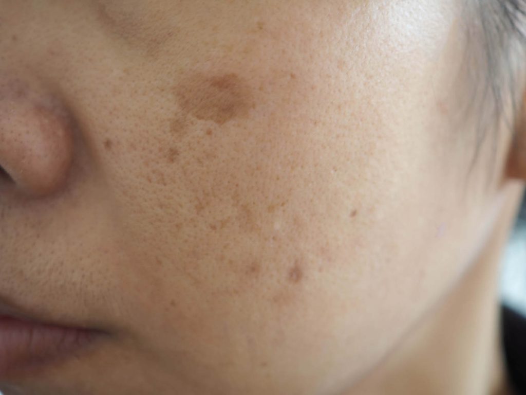 Melasma on Face in Singapore