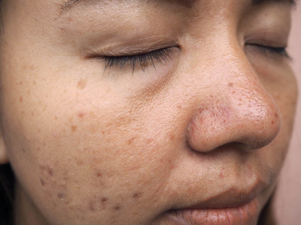 Melasma Causes in Singapore